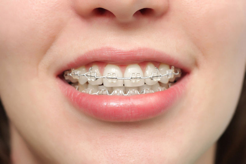Thời gian niềng răng có sự khác nhau ở từng người