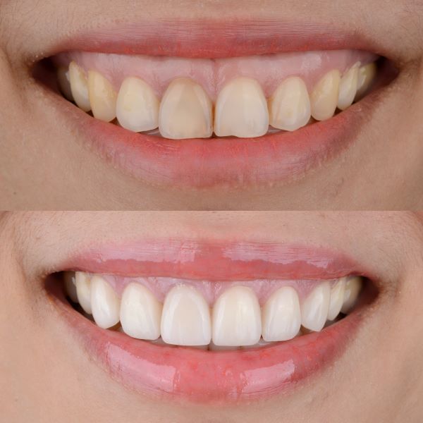 Niềng răng sai cách có thể gây cười hở lợi