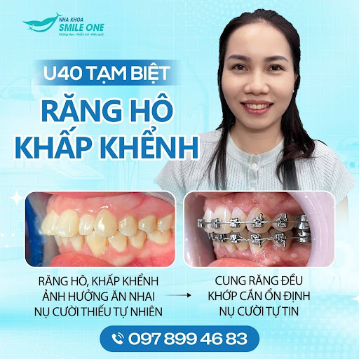 Khách hàng niềng răng thành công tại Smile One