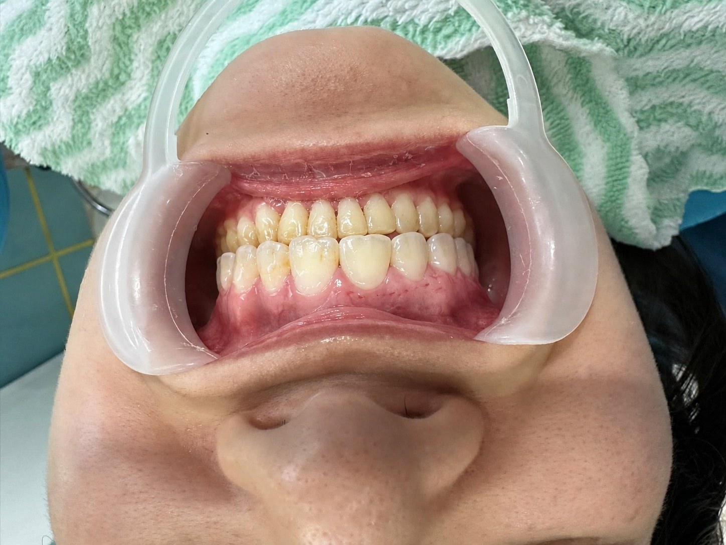 Tình trạng răng và khớp cắn của chị Huyền Trang khi niềng tại Smile One