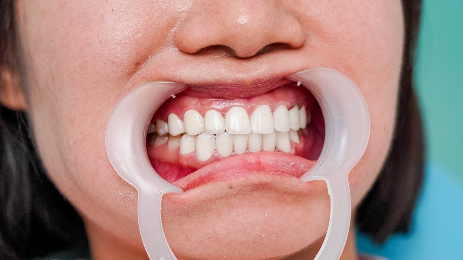 Răng chị Bích sau khi bọc sứ thẩm mỹ — trắng sáng, đều và cân đối hơn