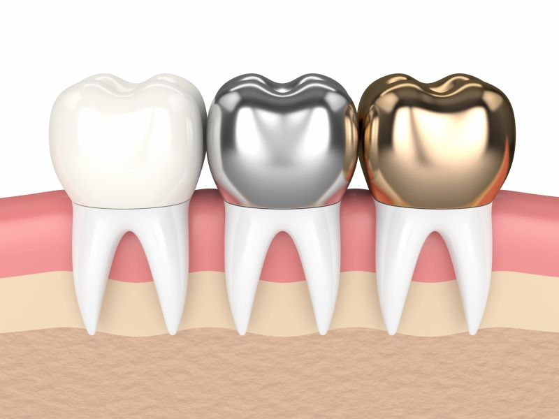Răng sứ kim loại là dòng răng sứ phổ biến