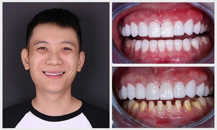Trường hợp mài răng khi thì chi phí chung sẽ cao hơn