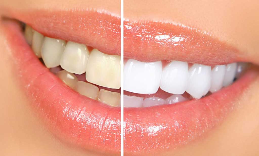 Tẩy trắng răng sử dụng các chất oxy hóa để làm trắng bề mặt răng