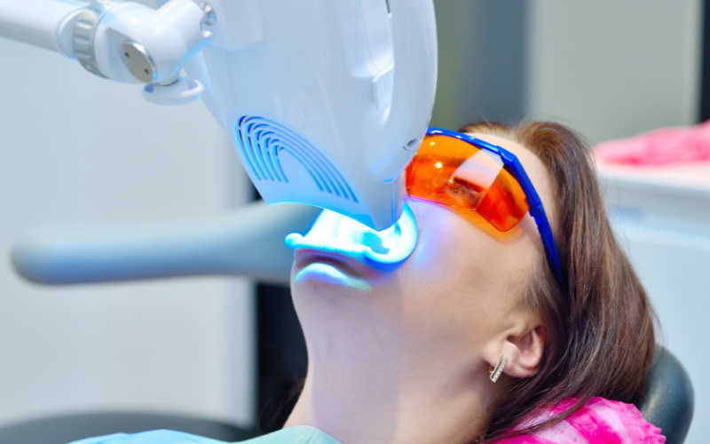 Tẩy trắng tại nha khoa bằng đèn/laser
