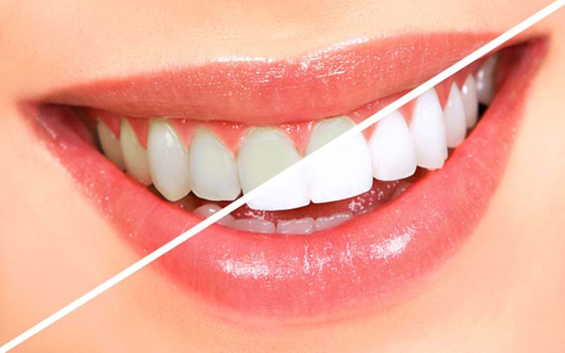 Tẩy trắng răng không làm hỏng men răng nếu làm đúng kỹ thuật
