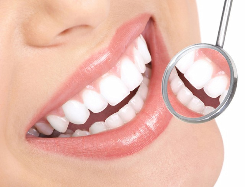 Tẩy trắng răng lên được 3 – 6 tông trên bảng màu chuẩn