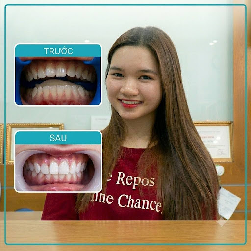 Case khách hàng tẩy trắng răng thành công tại Smile One