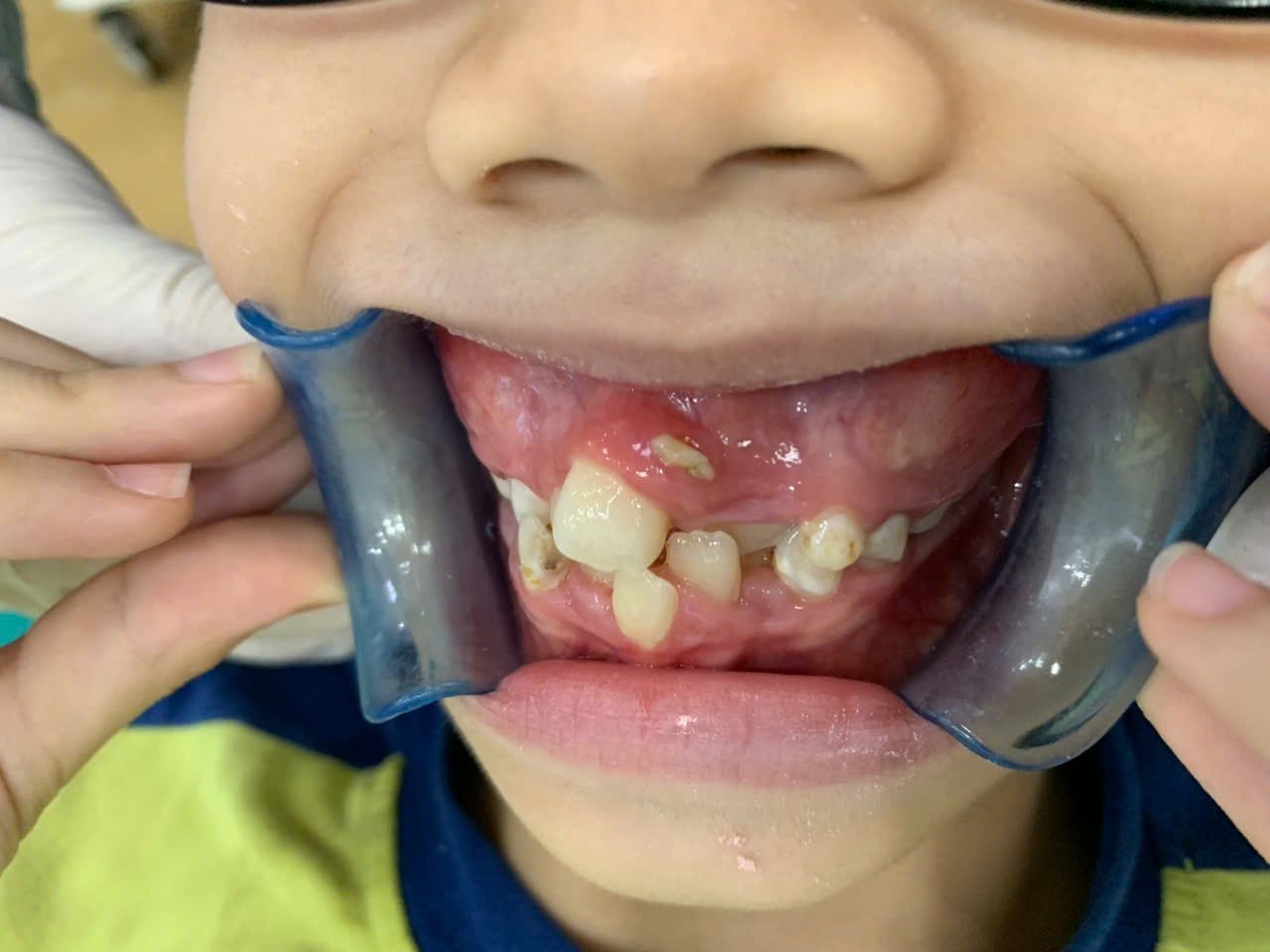 Tình trạng răng bé Thạch trước điều trị — răng chen chúc, thiếu chỗ ở giai đoạn răng hỗn hợp