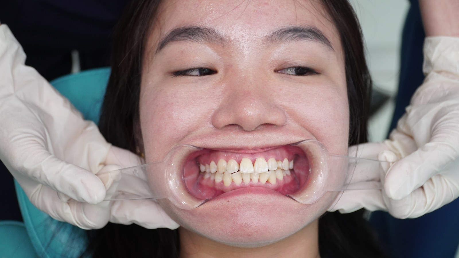Tình trạng răng chị Bích trước điều trị — răng xỉn màu, chìa nhẹ và chưa đều