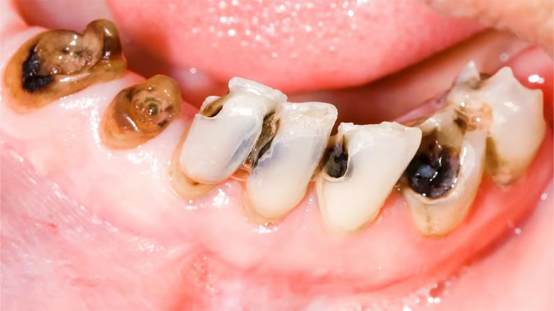 Thiếu Fluoride là nguyên nhân khiến cho đánh răng thường xuyên vẫn bị sâu răng