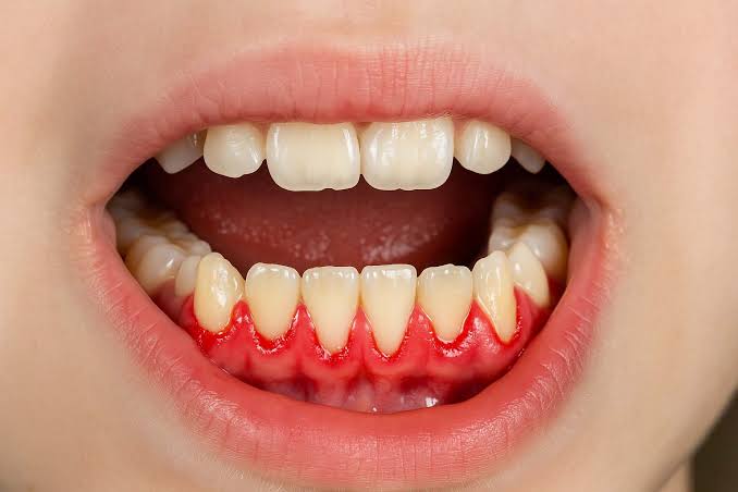 Viêm nướu là tổn thương nông, chỉ ở mô mềm (lợi)
