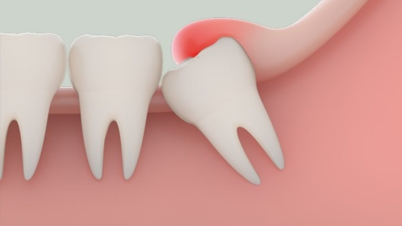 Răng khôn là chiếc răng hàm cuối cùng ở mỗi góc hàm