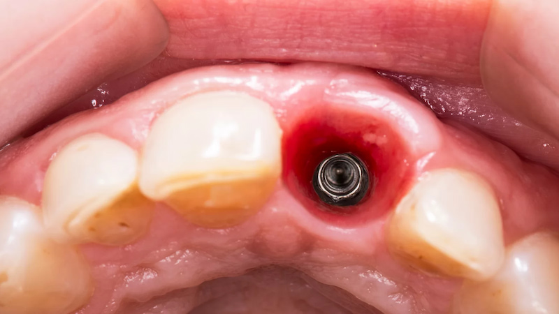 Trồng implant đơn lẻ