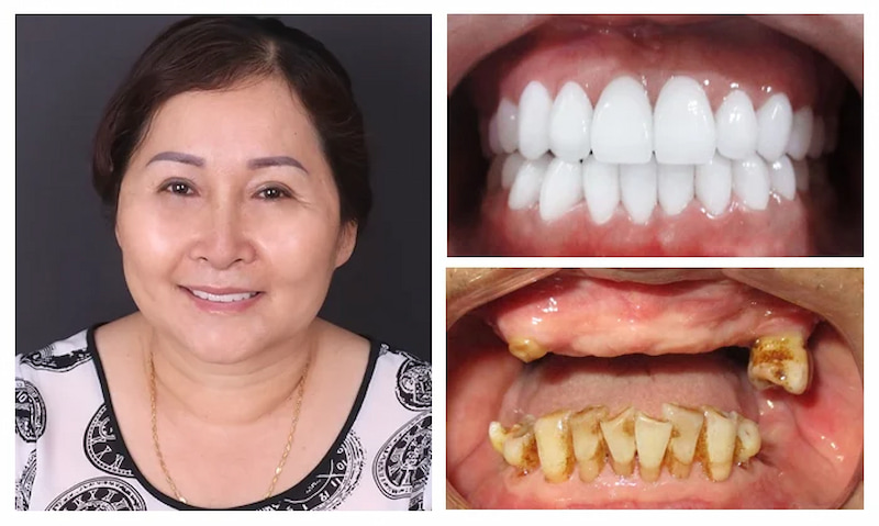 Giá Implant toàn hàm All-on-4/5/6 dao động từ 67 - 250 triệu đồng