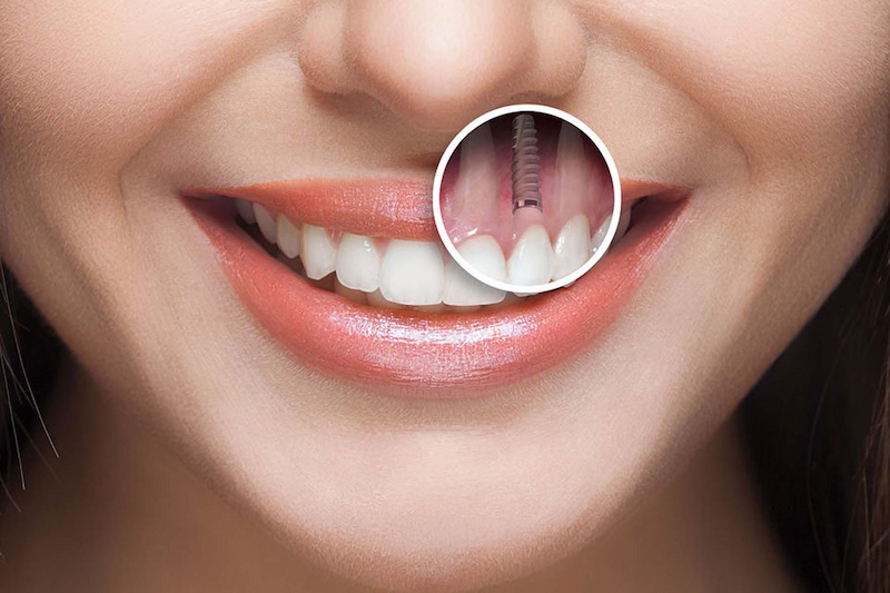 Trồng răng Iplant có tỷ lệ thành công rất cao