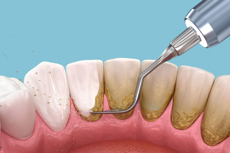 Cạo vôi răng định kỳ giúp kéo dài tuổi thọ sau trồng răng implant