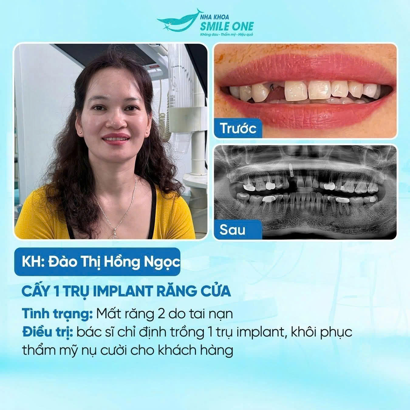 Khách hàng trồng răng Implant thành công tại Smile One