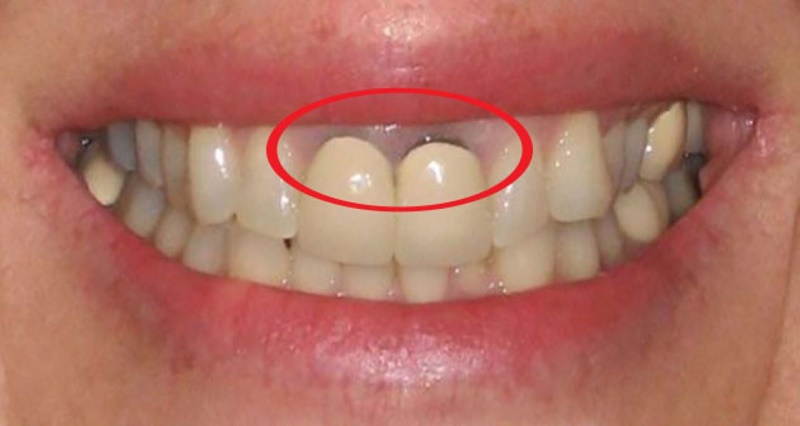 Bọc răng sứ bị thối thường là cách gọi dân gian của tình trạng