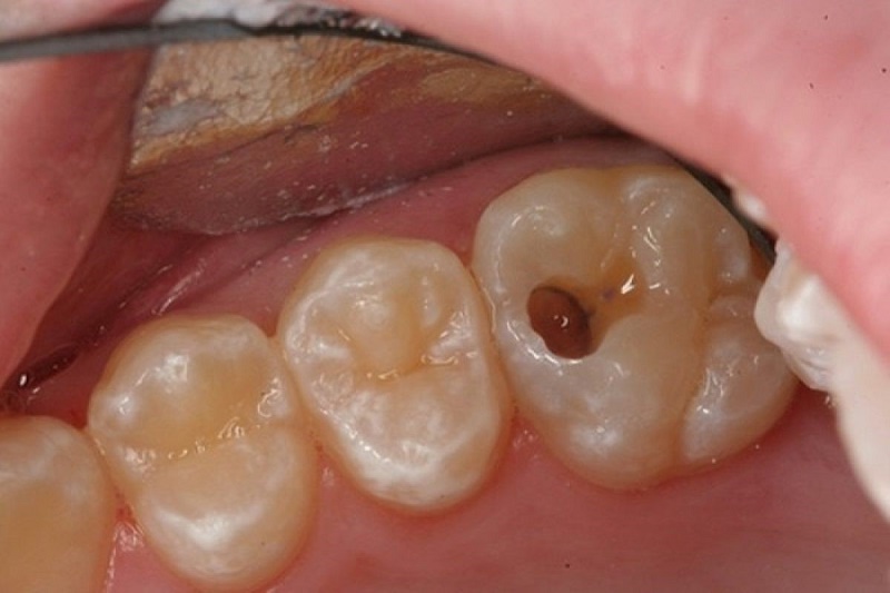 Bọc răng sứ bị hôi thối thường do mão sứ không khít, hở viền nướu,