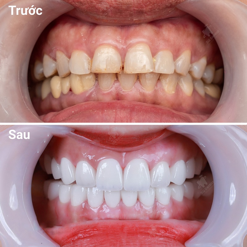 Bác sĩ cần chụp X-quang và phim sọ nghiêng để xác định dạng hô.
