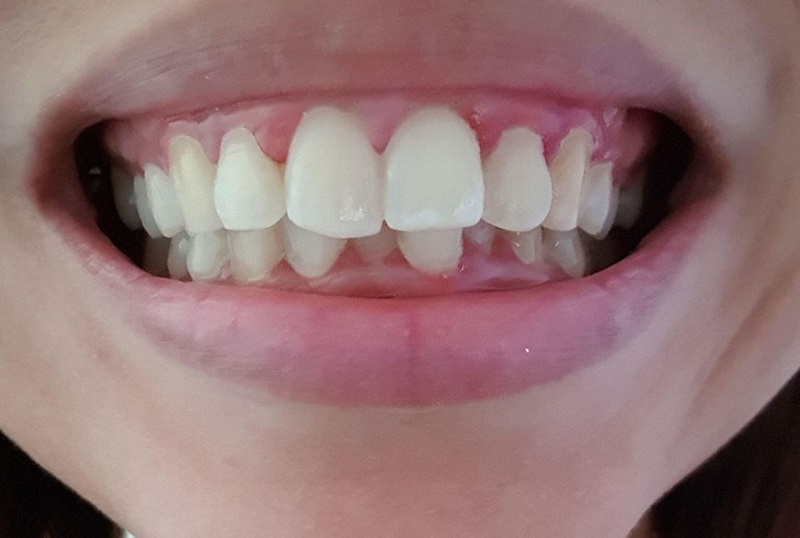 Bọc răng sứ không được chỉ định cho răng hô vẩu do sai lệch xương hàm,