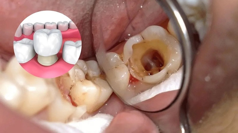 Răng thật bên trong vẫn bị sâu do vi khuẩn tồn tại ở kẽ răng