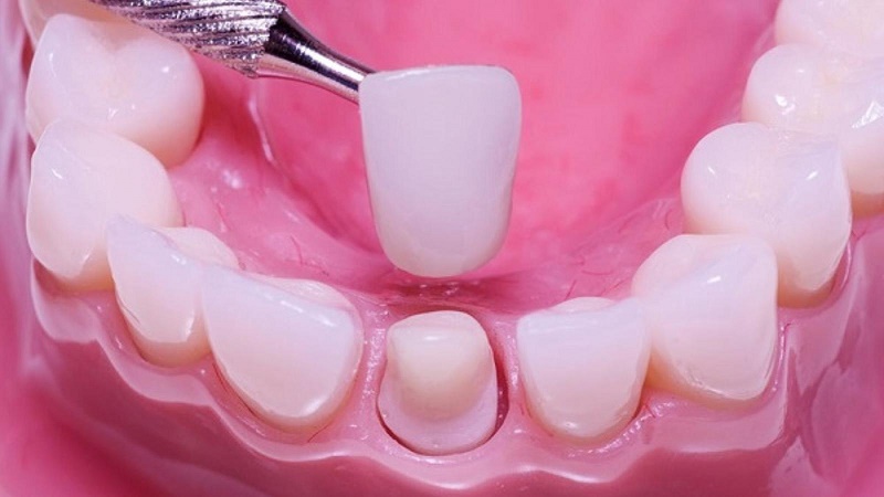 Bọc răng sứ có thể gây hại nếu mài răng sai tỷ lệ, bọc sai tình trạng răng
