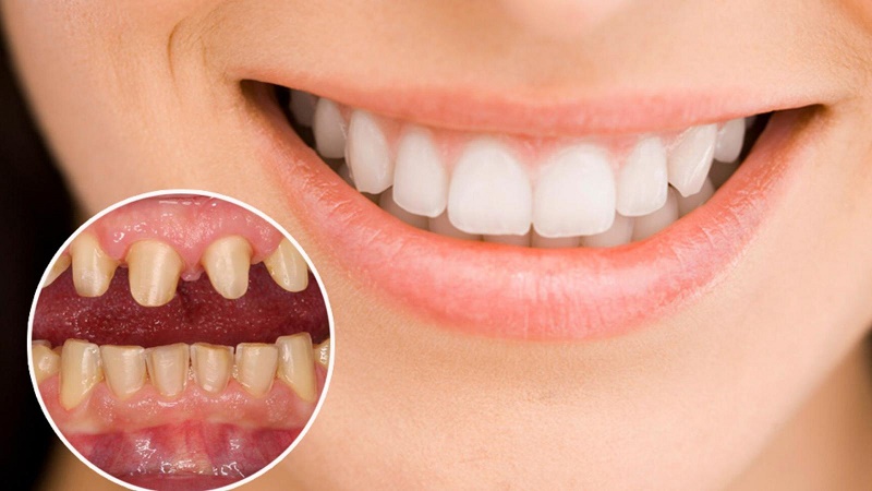 Nhóm tổn thương do sai chỉ định hoặc sai kỹ thuật khi bọc răng sứ thường gồm