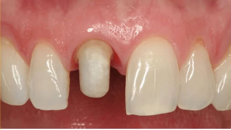 Những người không nên bọc răng sứ gồm răng quá yếu