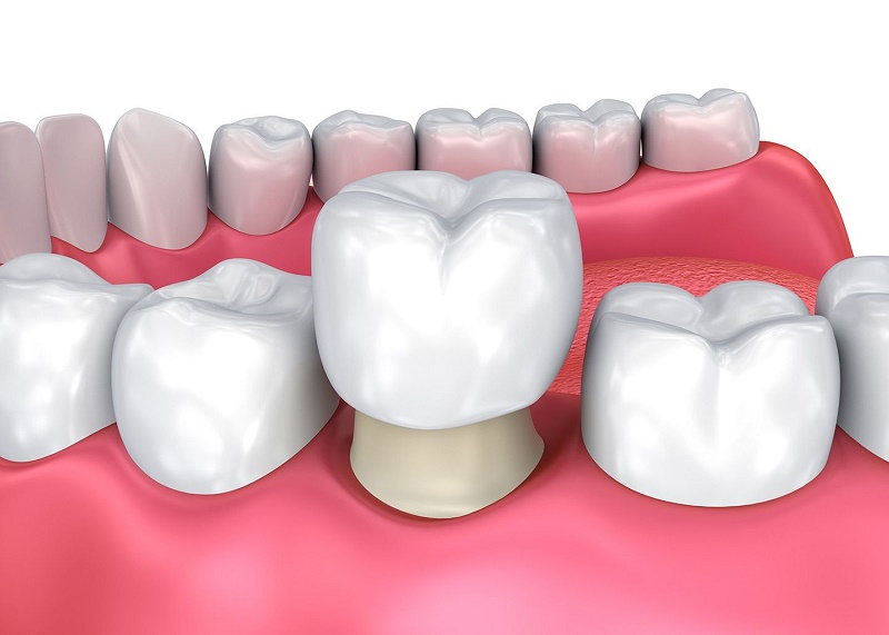 Bọc răng sứ an toàn khi khách hàng được chỉ định đúng,