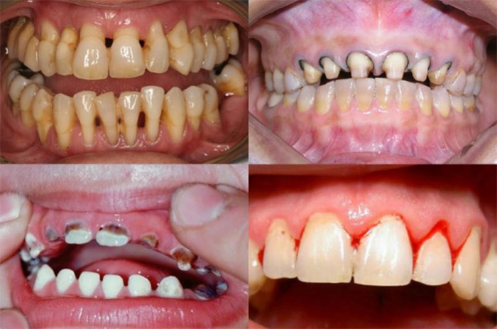 Bọc răng sứ có thể gây nguy hiểm nếu thực hiện sai kỹ thuật