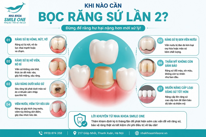 Cần bọc răng sứ lần 2 khi mão sứ cũ bị hở, nứt vỡ, cộm cấn, đổi màu, gây đau nhức,