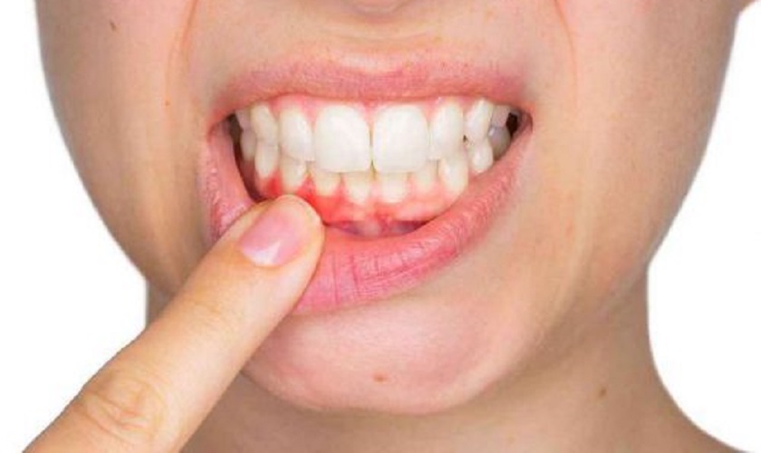 Ê buốt trong 1-2 tuần đầu sau bọc răng sứ phần lớn