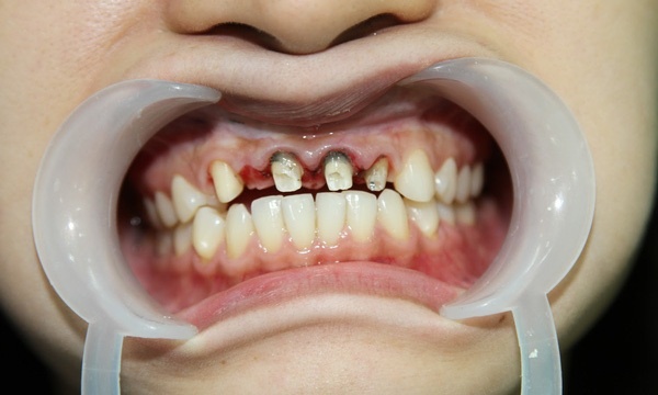 Ê buốt sau bọc sứ có thể bình thường trong 1–3 ngày đầu