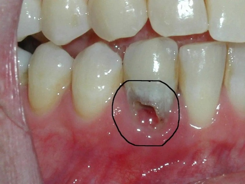 Tiêu xương răng chữa được, nhưng bắt buộc phải can thiệp tại nha khoa xương