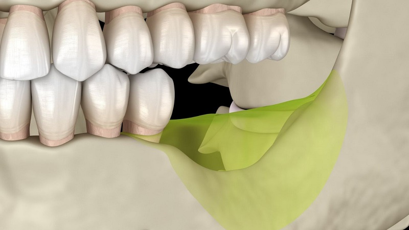 Ngay cả trường hợp mất răng nhiều năm và xương đã tiêu nhiều