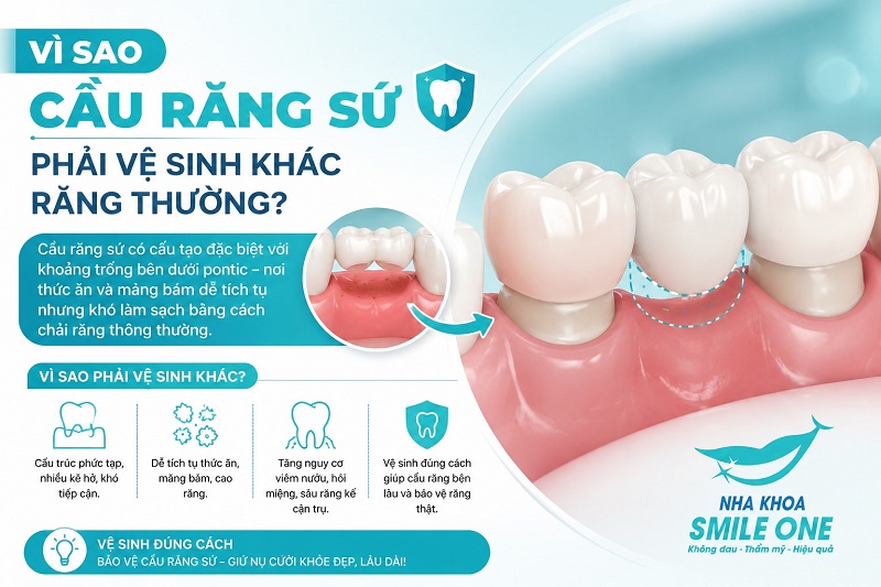 Cầu răng sứ là một dải mão dính liền, có nhịp cầu (răng giả) bắc qua khoảng mất răng, tựa lên nướu