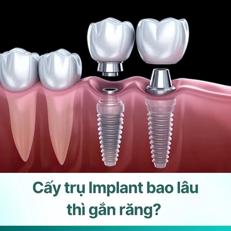 sau khi cấy trụ Implant sẽ cần chờ khoảng 3-6 tháng