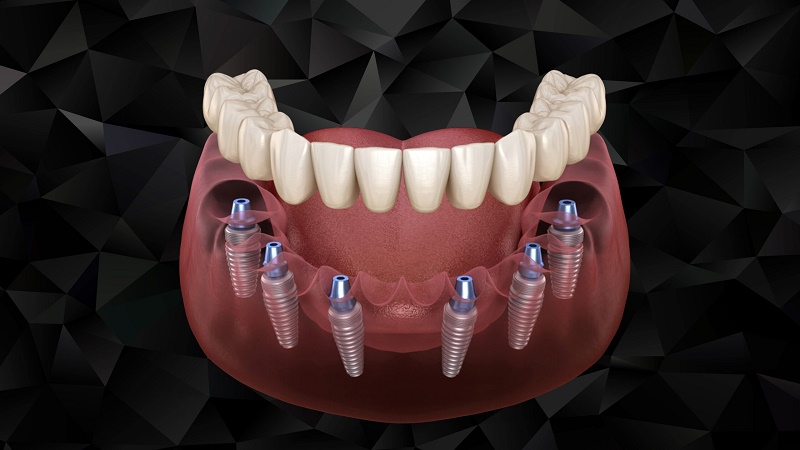 Thời gian chờ gắn răng phụ thuộc vào tình trạng răng miệng,