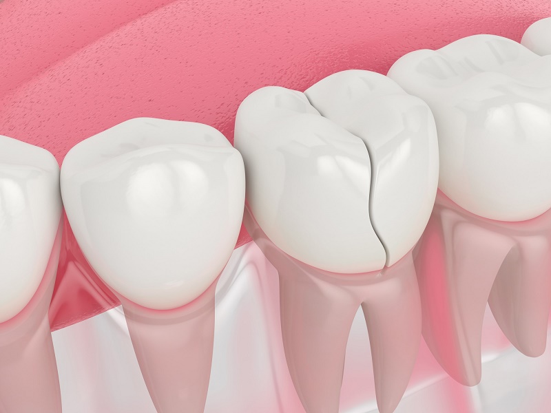 Về sau, khe hở tích tụ thức ăn và mảng bám còn có thể gây hơi thở có mùi.