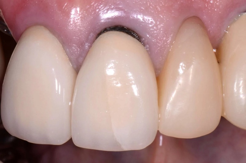 Dấu hiệu có thể nhìn thấy bằng mắt thường gồm các đốm trắng