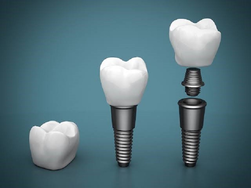 Healing Abutment, hay trụ lành thương, là một khớp nối tạm bằng Titanium