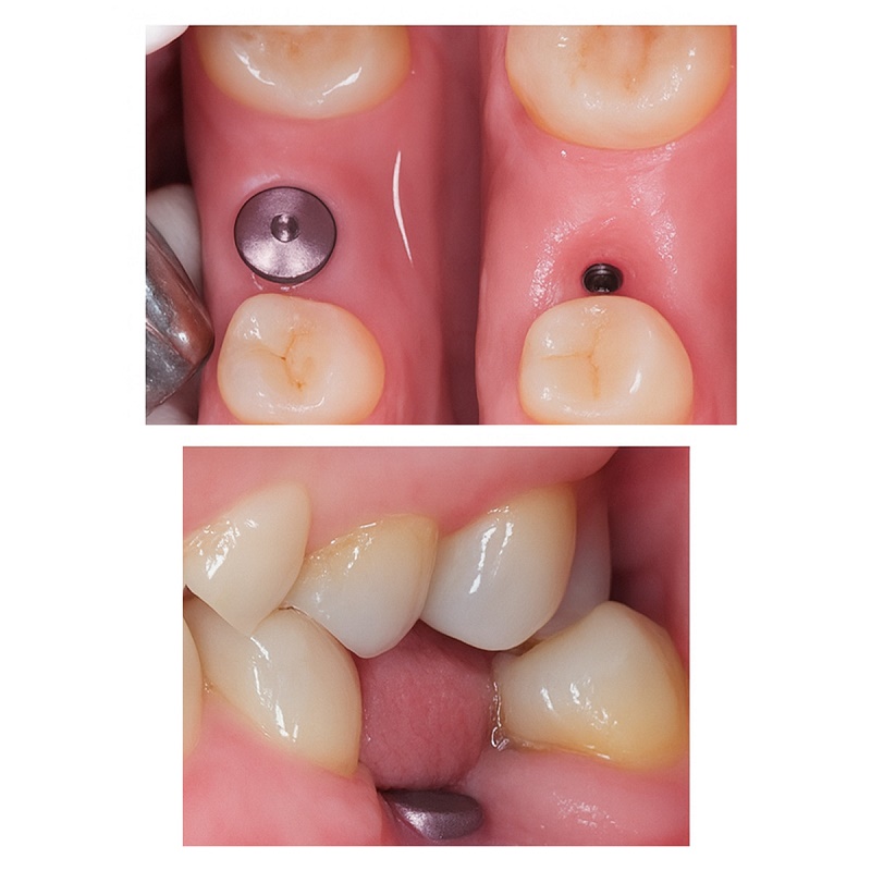 Chăm sóc khi đeo Healing Abutment bằng cách vệ sinh nhẹ nhàng