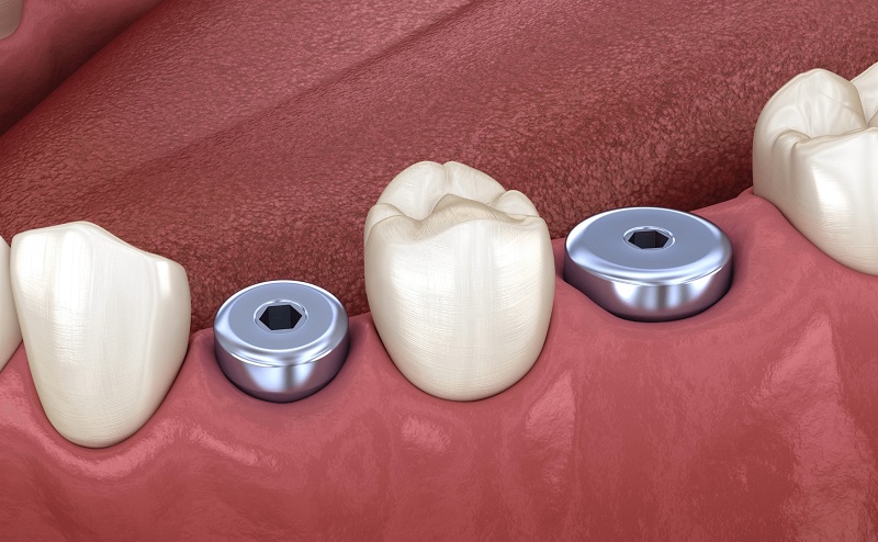Healing Abutment khác abutment phục hình và vít đậy