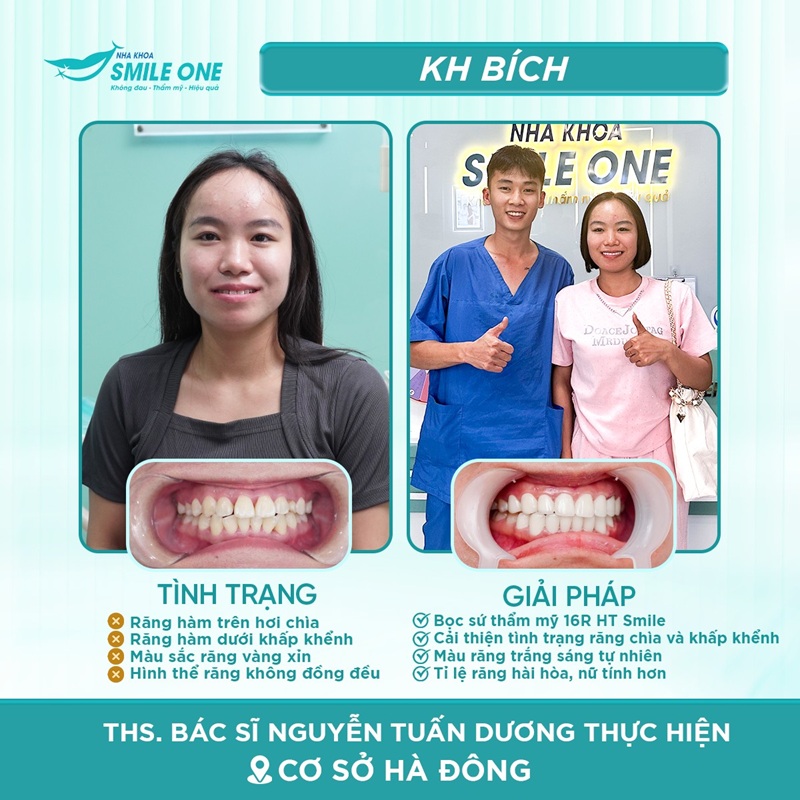 Kết quả bọc răng sứ thẩm mỹ của chị Bích tại Nha khoa Smile One