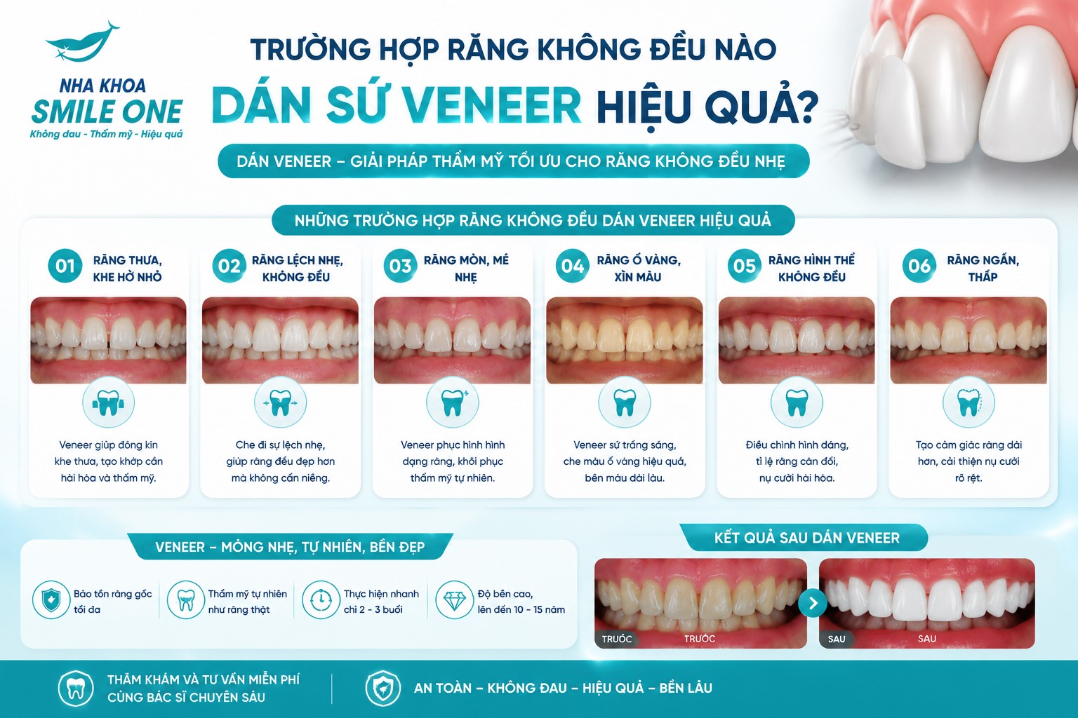 Trường hợp răng không đều nào dán sứ Veneer hiệu quả?