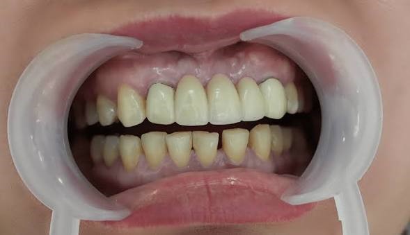 Nguyên nhân khiến răng sứ bị đổi màu