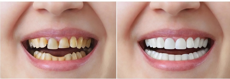 Cách chăm sóc phòng ngừa răng sứ xuống màu