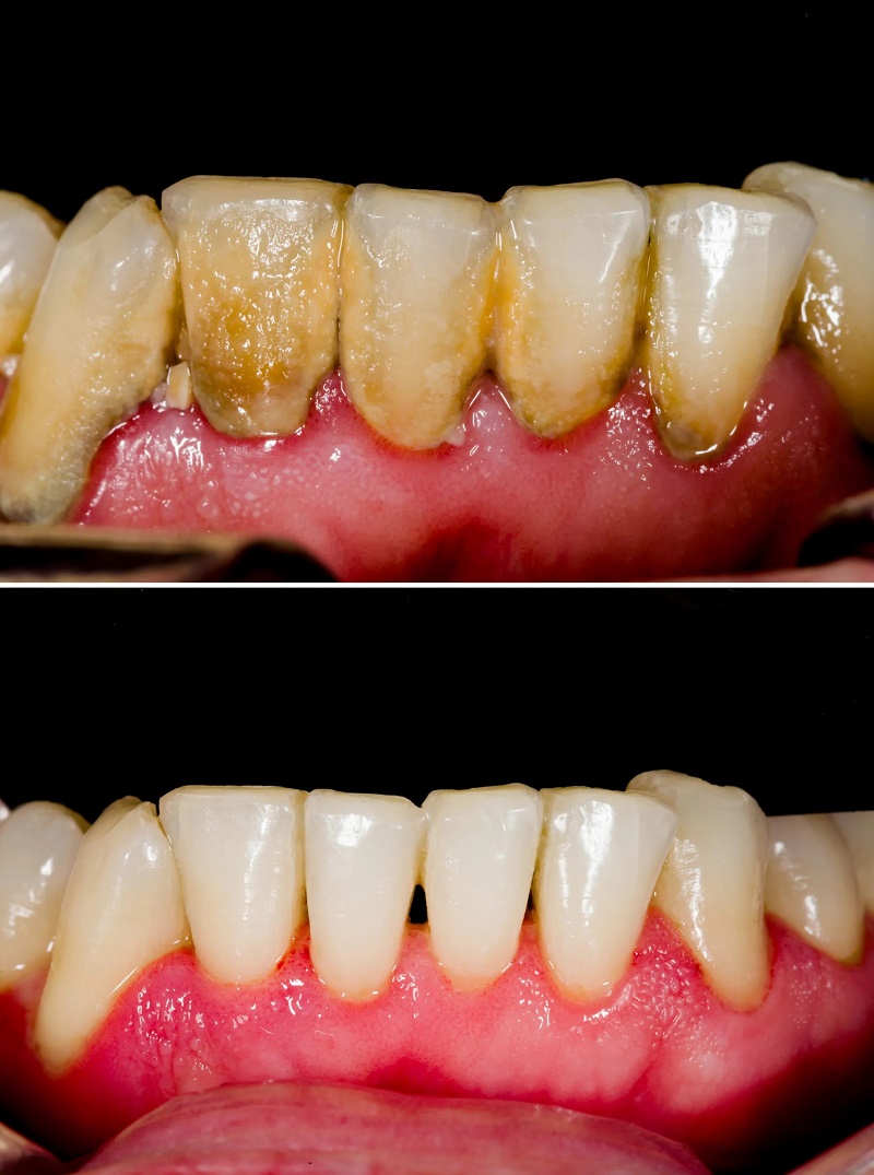 Cạo vôi răng sứ không gây ảnh hưởng nếu được thực hiện đúng kỹ thuật,